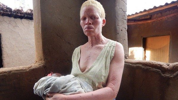O albinismo é um distúrbio congênito caracterizado pela ausência de pigmento na pele, cabelos e olhos (Foto: BBC).