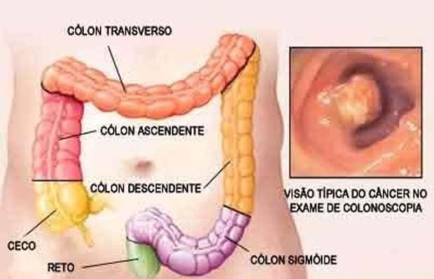 Ilustração: combateaocancer.com
