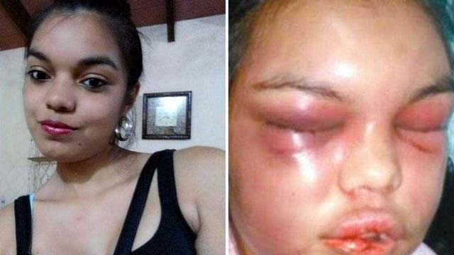 Adolfina Camelli Ortigoza era agredida e teve o rosto desfigurado pelo companheiro, de 32 anos. Foto: Aominuto.com