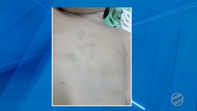 Hematomas pelo corpo de Rian Vinícius que morreu horas depois de chegar ao hospital de Corumbá (MS) (Foto: Reprodução/TV Morena).