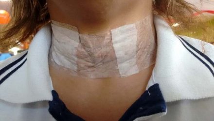 Mulher sofreu corte no pescoço provocado por linha com cerol. Foto: DIVULGAÇÃO