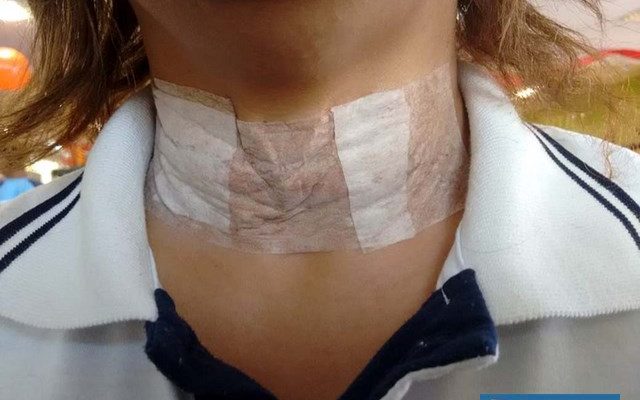 Mulher sofreu corte no pescoço provocado por linha com cerol. Foto: DIVULGAÇÃO