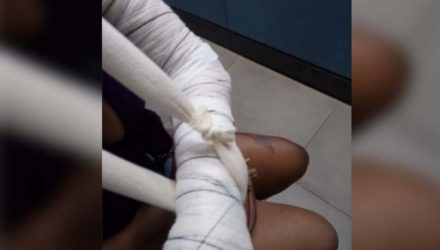 Jovem teve o membro superior esquerdo fraturado pelo padrasto e ainda foi agredida pelo namorado. Foto: MANOEL MESSIAS/Agência