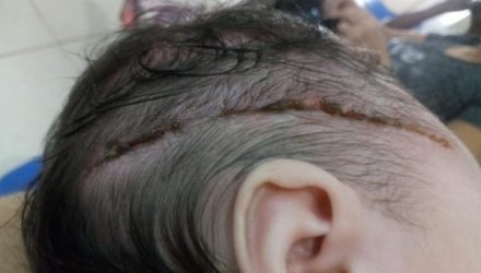 Bebê levou 25 pontos na cabeça após corte causado por bisturi durante parte em Araçatuba (SP) — Foto: Arquivo pessoal