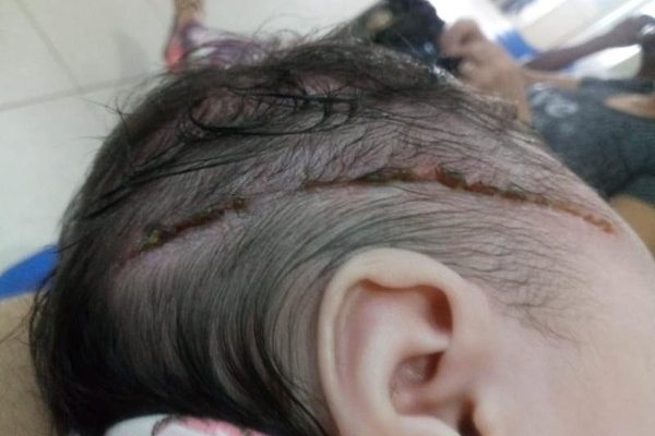 Bebê levou 25 pontos na cabeça após corte causado por bisturi durante parte em Araçatuba (SP) — Foto: Arquivo pessoal