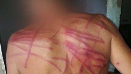 Marcas da agressão em jovem com esquizofrenia no Chapadão — Foto: Reprodução/TV Globo.