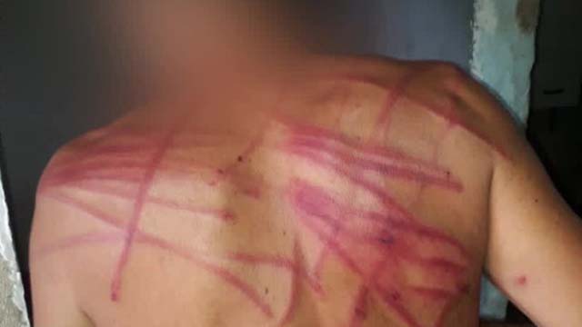 Marcas da agressão em jovem com esquizofrenia no Chapadão — Foto: Reprodução/TV Globo.