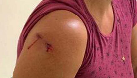 Dona de casa levou um tiro no braço direito, altura do ombro, que transfixou o tecido adiposo, sem muita gravidade. Foto: DIVULGAÇÃO