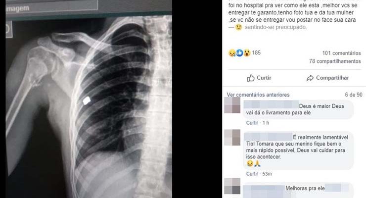 Pai divulgou imagem de raio X de adolescente baleado em Piraju (SP) — Foto: Reprodução/Facebook.