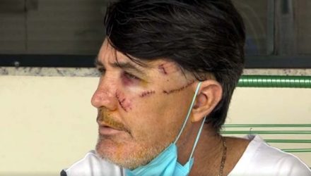 Odair Righi Reganham foi atacado por cães da raça pitbull — Foto: Reprodução/TV Fronteira