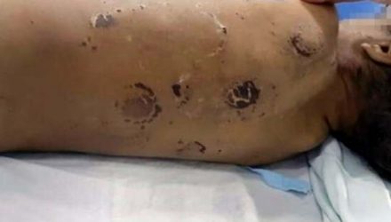 Menino apresentava traumatismo craniano, marcas de queimaduras de cigarro e fraturas nas costelas. Foto: DIVULGAÇÃO