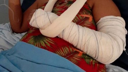 Mulher sofreu fratura do braço esquerdo, contusões e escoriações pelo corpo, além de traumatismo craniano leve. Foto: Arquivo Pessoal