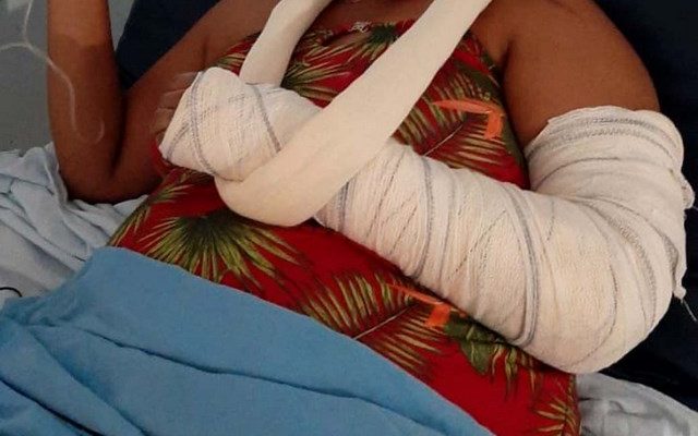 Mulher sofreu fratura do braço esquerdo, contusões e escoriações pelo corpo, além de traumatismo craniano leve. Foto: Arquivo Pessoal