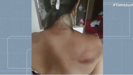 Simone ficou com marcas pelo corpo após ser agredida com cinto pelo prefeito de Barra do Mendes — Foto: Reprodução/ TV Bahia