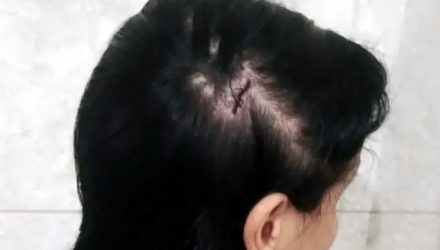 Vereador é investigado suspeito de causar corte na cabeça da esposa após agressão em Severínia — Foto: Arquivo pessoal