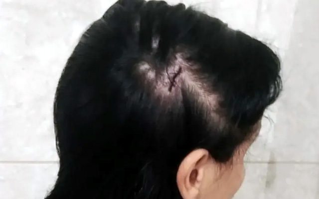 Vereador é investigado suspeito de causar corte na cabeça da esposa após agressão em Severínia — Foto: Arquivo pessoal