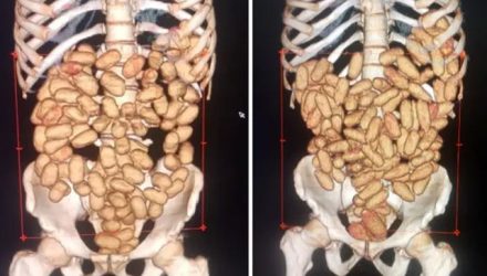 Exames de raio-x mostram cápsulas com cocaína dentro dos estômagos de estrangeiros — Foto: Divulgação