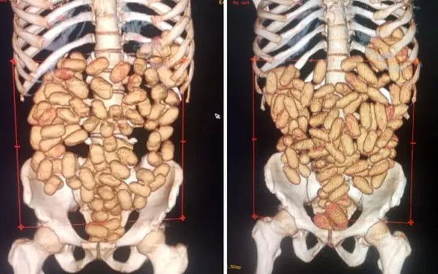 Exames de raio-x mostram cápsulas com cocaína dentro dos estômagos de estrangeiros — Foto: Divulgação